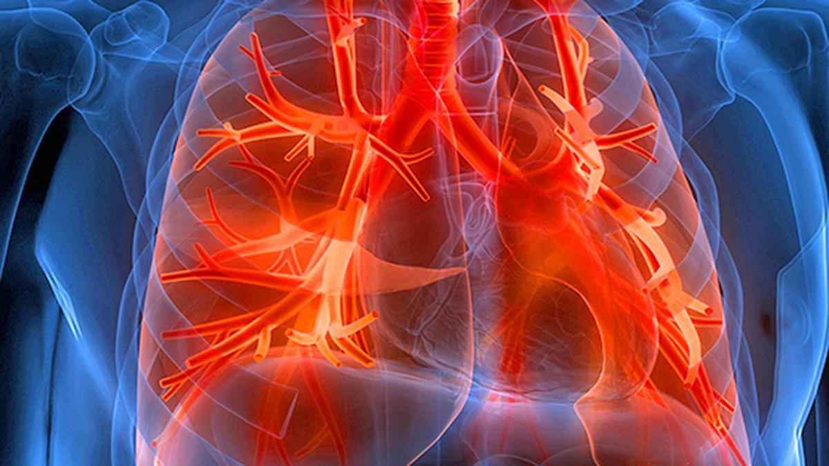 Idiopathic Pulmonary Fibrosis (IPF): Understanding a Devastating Lung Disease